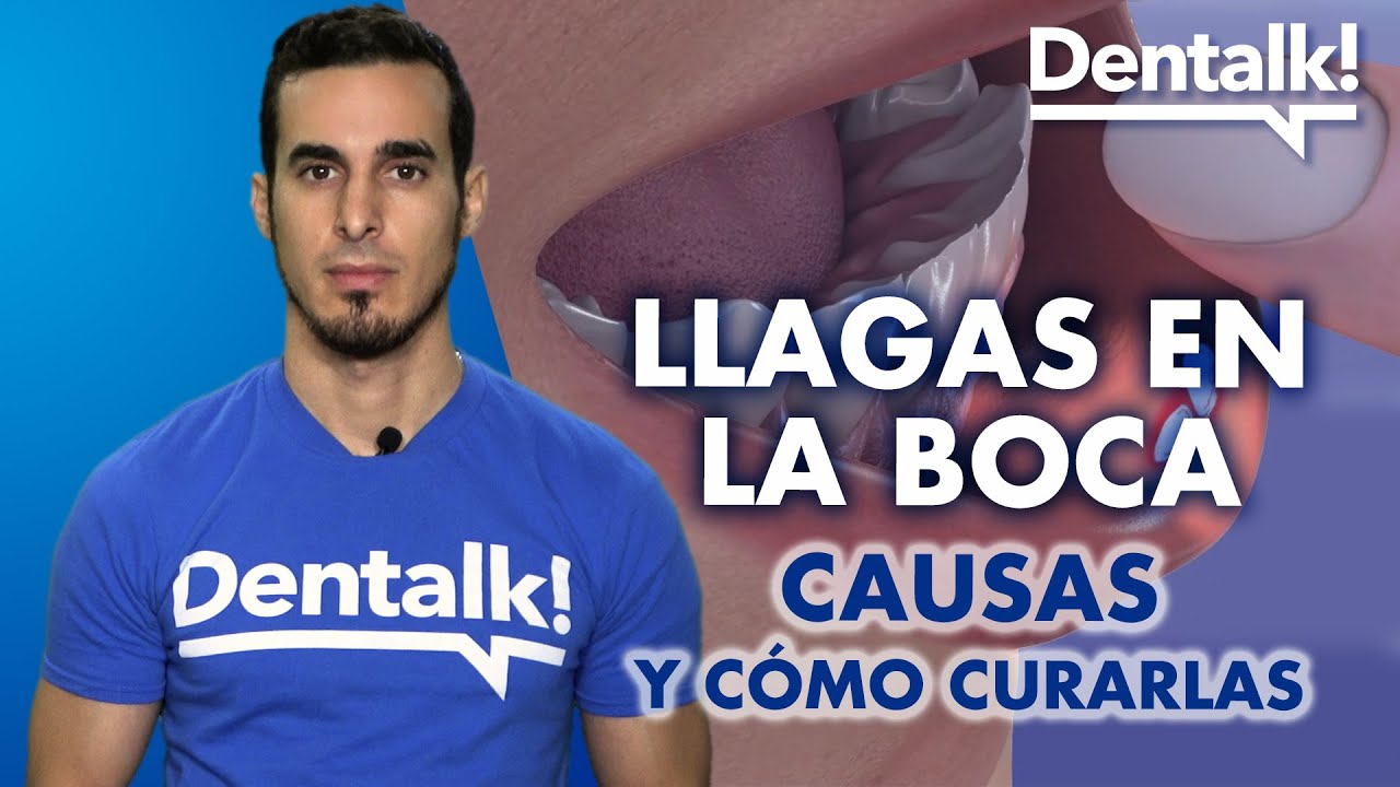 que se puede poner en una llaga en la boca